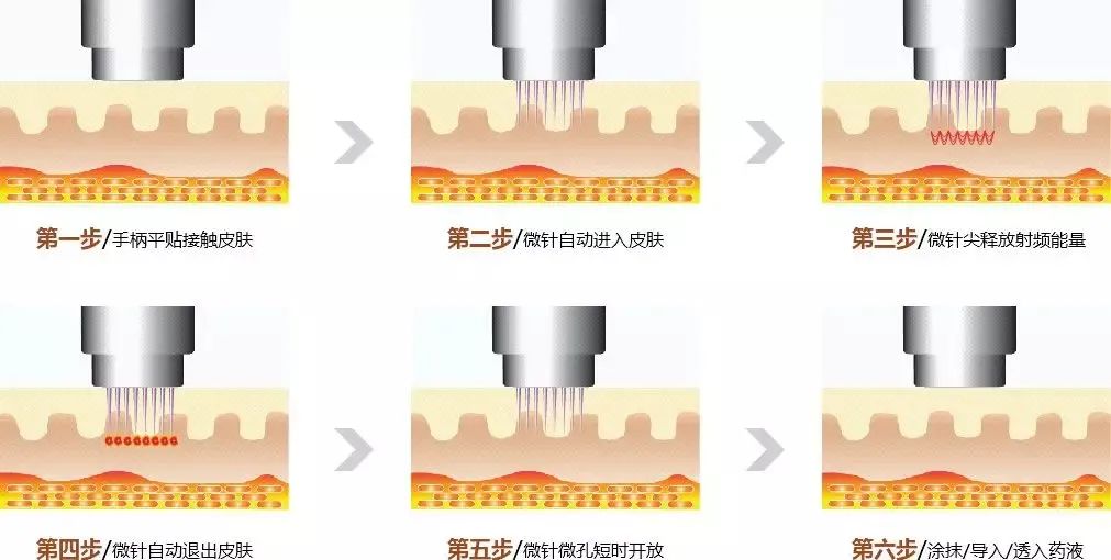 热玛吉、黄金微针 丨抗衰爆品实战话术大全