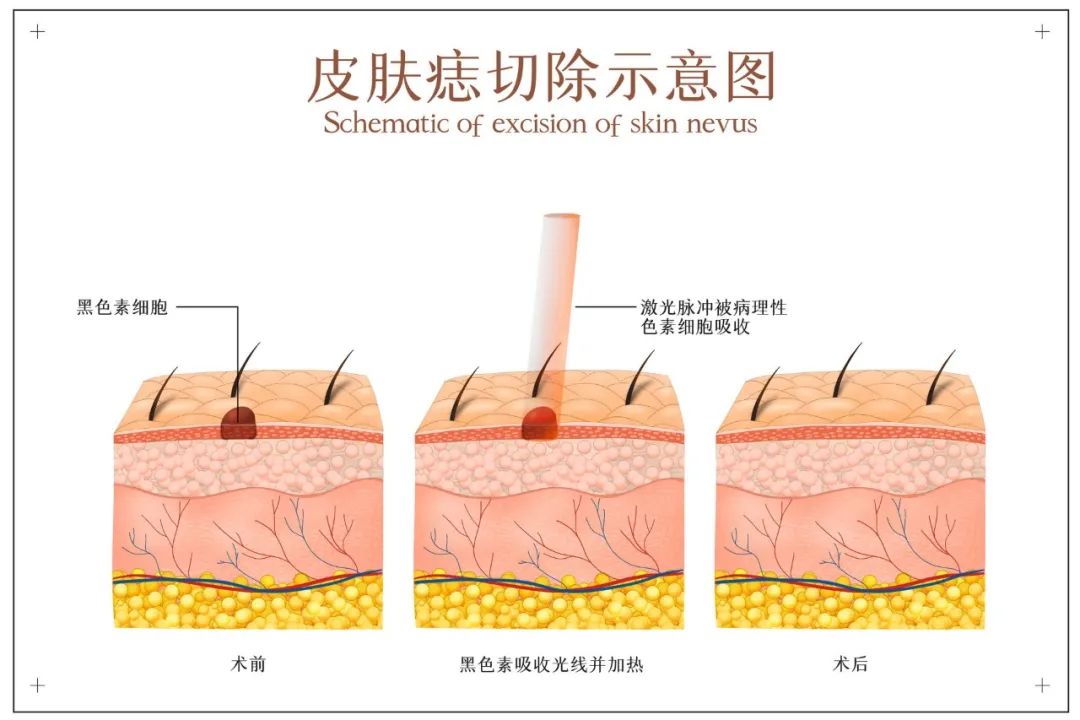 痣为什么会长毛，是皮肤癌的的表现吗？6种痣或与癌症密不可分