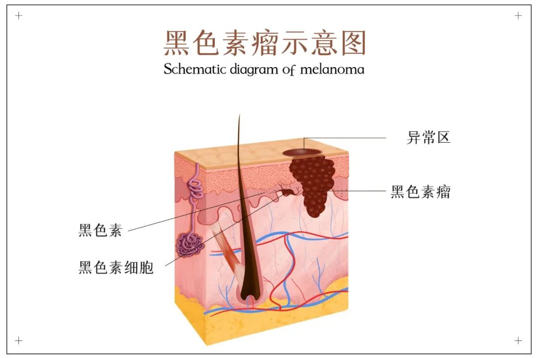 痣为什么会长毛，是皮肤癌的的表现吗？6种痣或与癌症密不可分