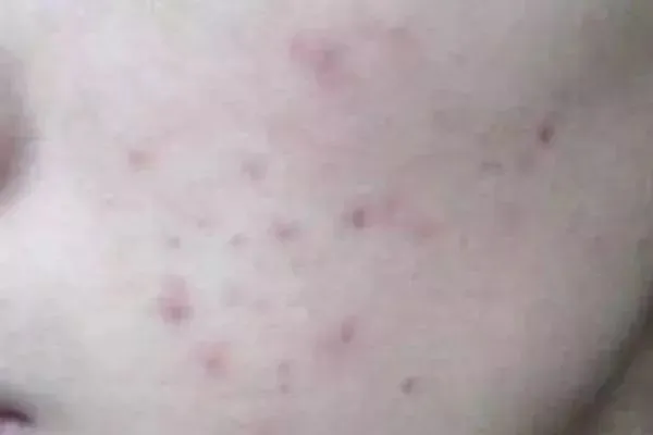 消除发炎痘印能通过医美恢复到正常皮肤吗？