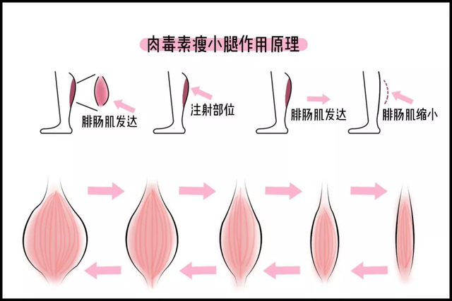 以下这几种小粗腿，一定要打瘦腿针！