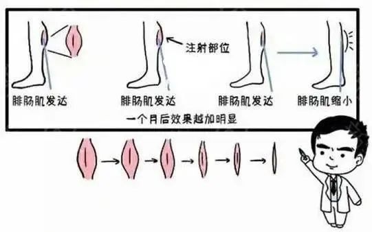 以下这几种小粗腿，一定要打瘦腿针！