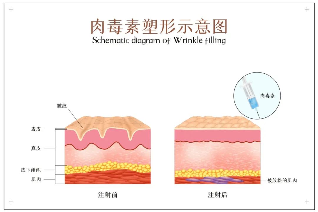 法令纹的不同成因和治疗方法