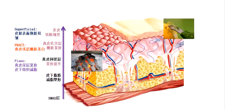 只用不懂？浅谈热玛吉与Fotona4D技术原理