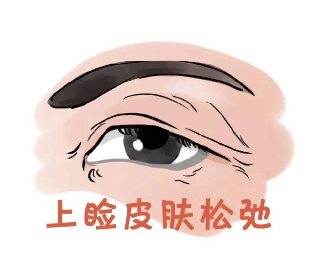 医美篇丨上眼皮松弛怎么办？做双眼皮还是提眉？