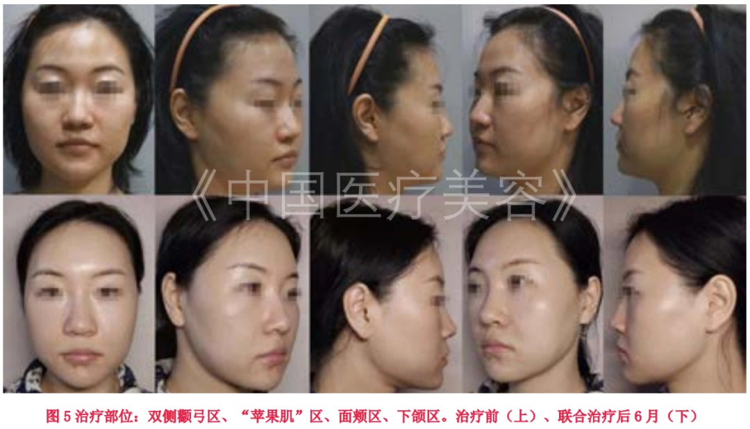【美容外科】面部低负压吸脂联合低能量双极射频在面部塑形和面部年轻化的应用