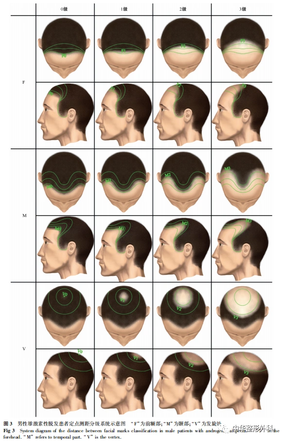 定点测距分级在男性雄激素性脱发中的适用性研究