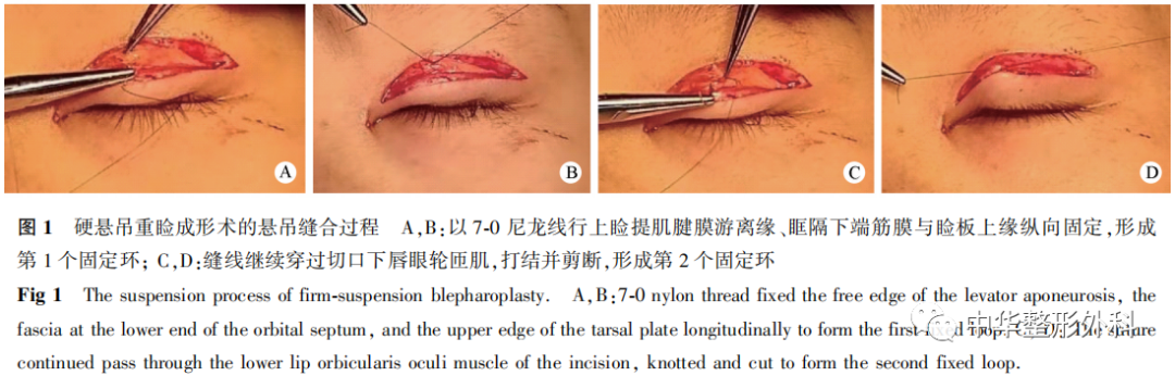 硬悬吊技术在东方人重睑成形术中的临床应用