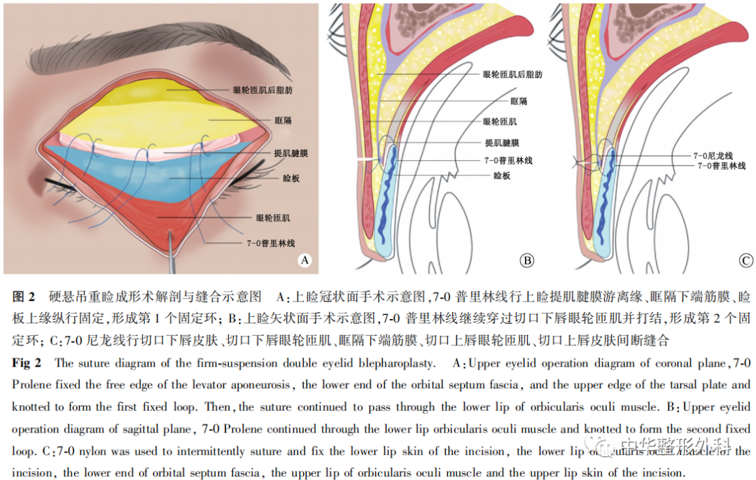 硬悬吊技术在东方人重睑成形术中的临床应用