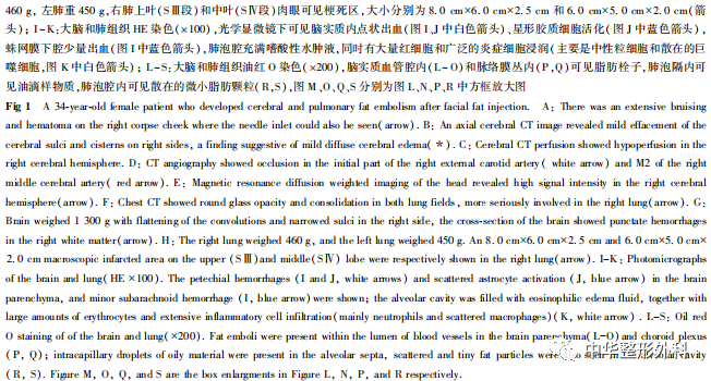 面部自体脂肪注射后脑和肺部脂肪栓塞1例