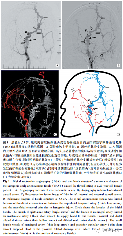 埋线美容致高流量头皮动静脉瘘经血管内介入治疗1例