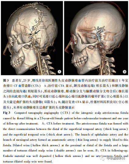 埋线美容致高流量头皮动静脉瘘经血管内介入治疗1例