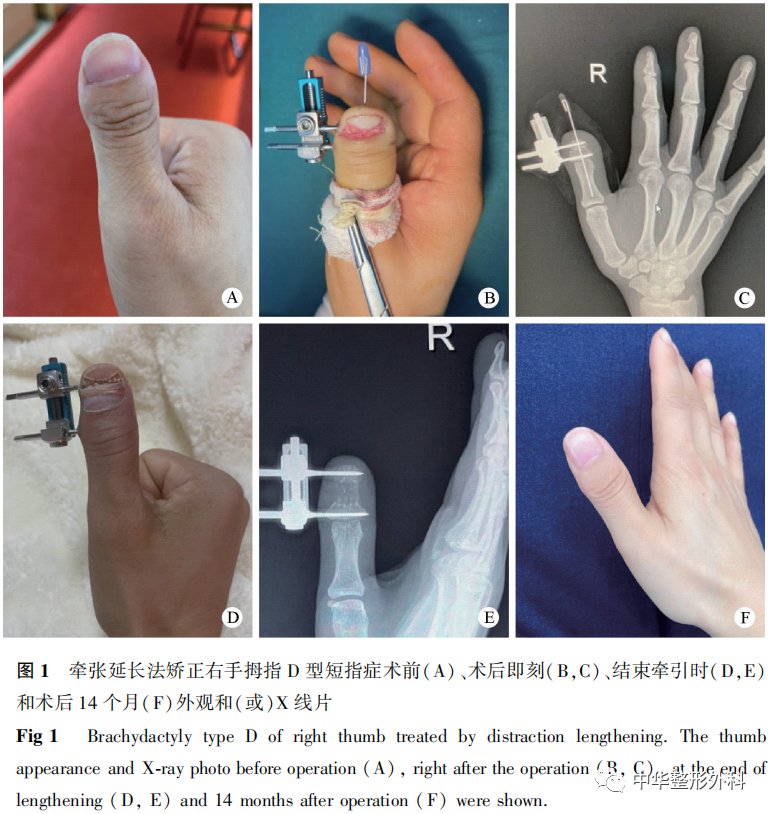 应用牵张延长法矫正单侧D型短指症的短甲畸形