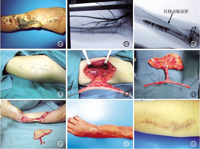 数字减影血管造影技术在股前外侧皮瓣修复上肢创面时判断受区血管损伤中的应用