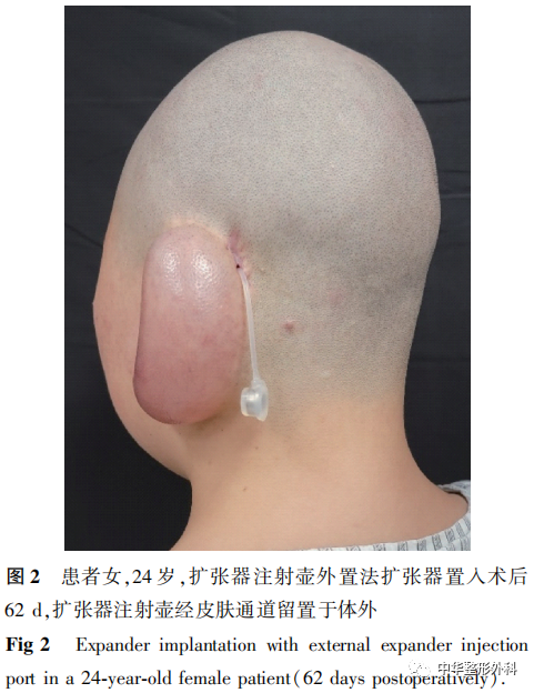 扩张器注射壶安置方式对耳后扩张器置入术后并发症发生的影响及处理策略