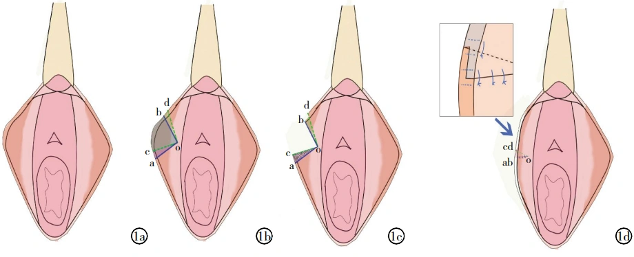 交错皮瓣楔形切除法在小阴唇缩小术中的临床应用