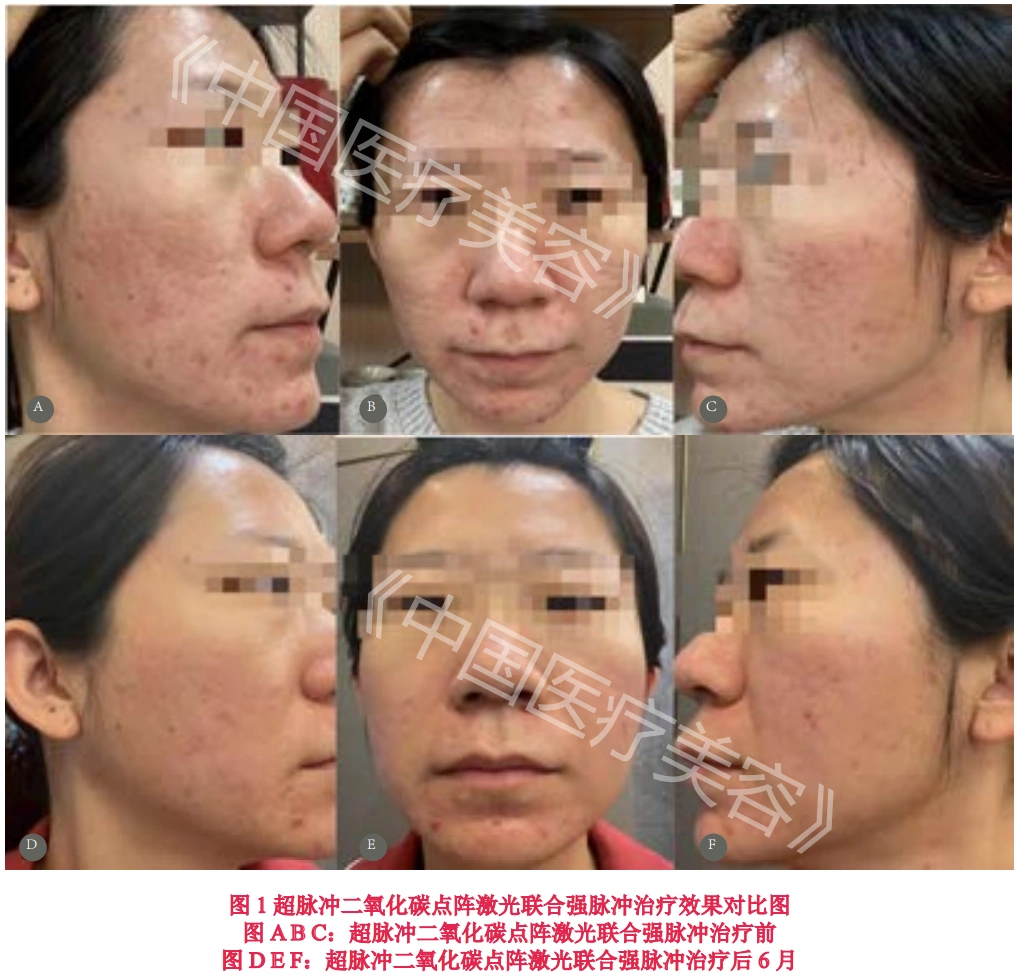 【皮肤美容】超脉冲二氧化碳点阵激光联合强脉冲光治疗面部痤疮凹陷性瘢痕的疗效分析