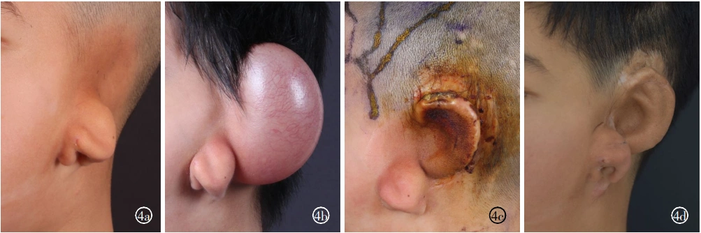 扩张双瓣法耳郭再造术后软骨外露的临床分析及处理策略