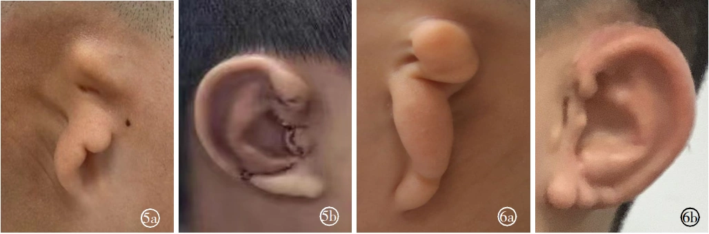 3D 打印技术在耳郭再造术中的应用