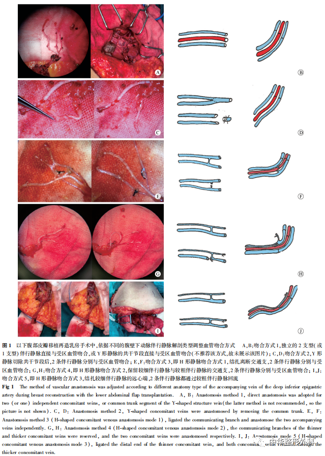 腹壁下动脉伴行静脉分型及吻合策略在乳房再造中的应用