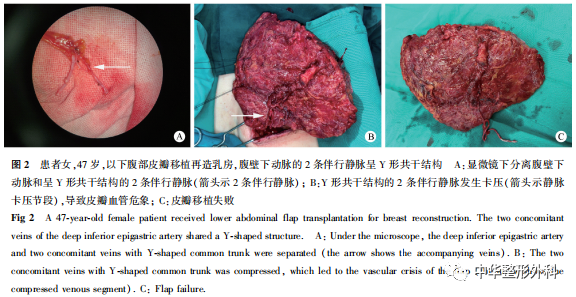 腹壁下动脉伴行静脉分型及吻合策略在乳房再造中的应用