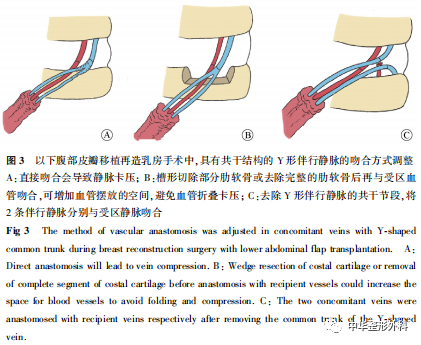 腹壁下动脉伴行静脉分型及吻合策略在乳房再造中的应用