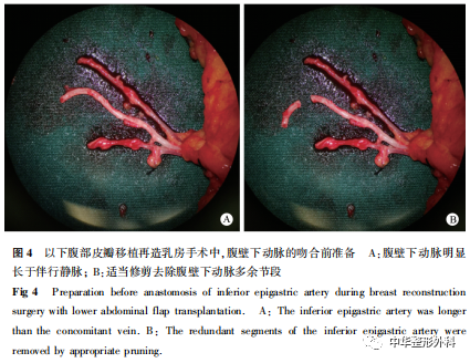 腹壁下动脉伴行静脉分型及吻合策略在乳房再造中的应用