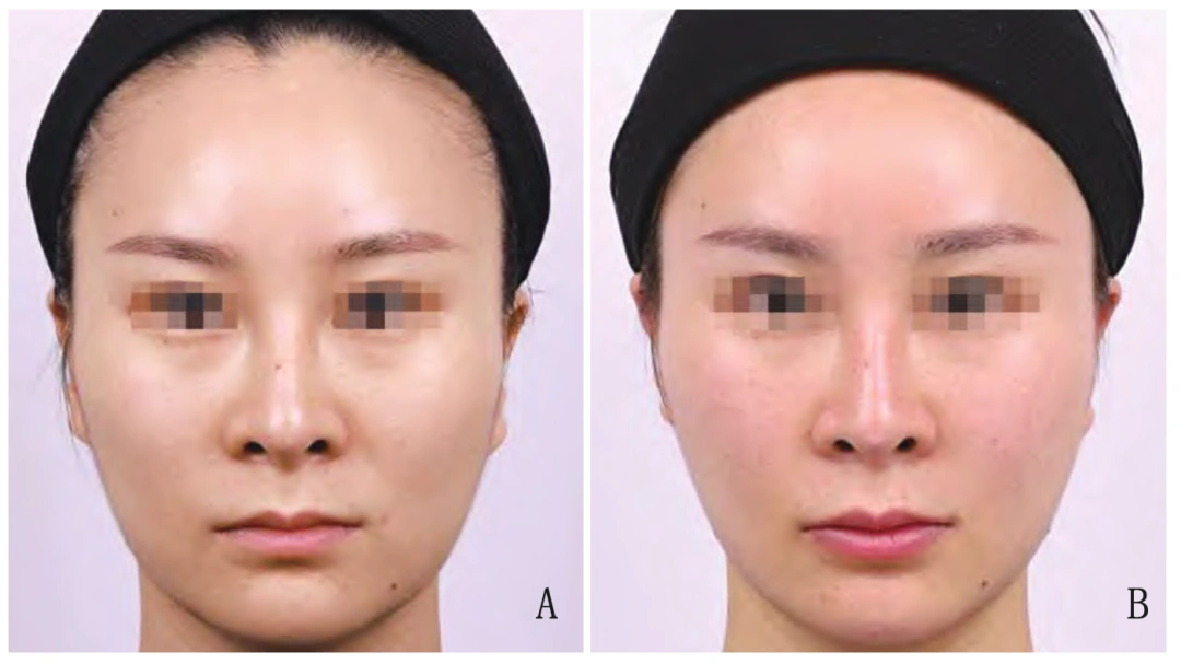 姣兰玻尿酸VOA™泛口周年轻化文献发表中国美容医学杂志|国产首款获批唇部适应症玻尿酸！