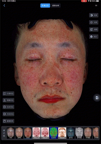 采美科普：美际3D皮肤分析仪如何利用数据构建信任，​打造医美数字化生态体系？