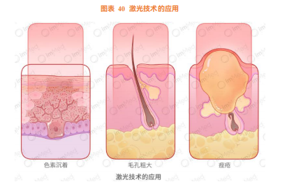 医美激光市场：需求强烈，市场空间大，技术壁垒高