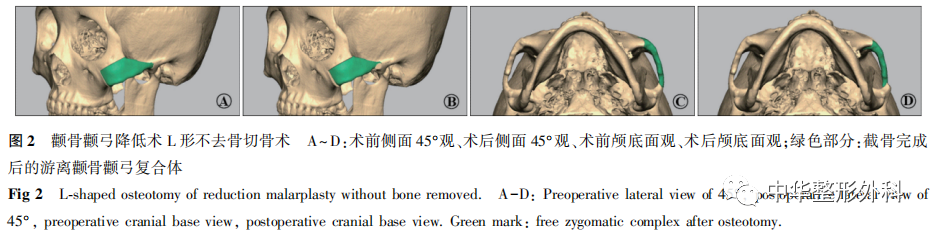 颧骨颧弓降低术的手术设计及临床应用