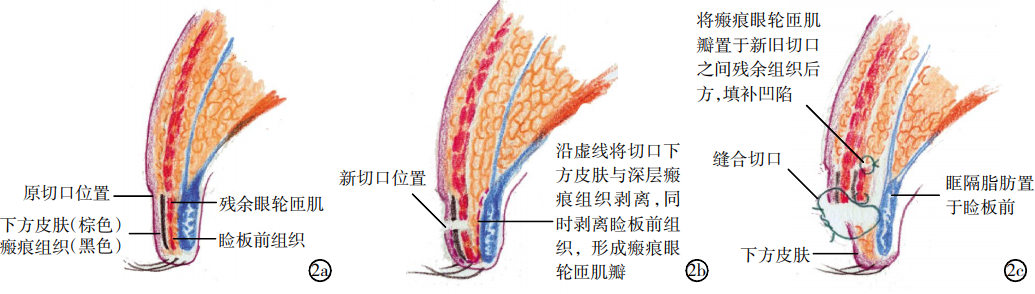 瘢痕眼轮匝肌瓣修复过宽重睑效果分析