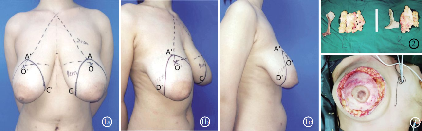 改良双环形切口真皮乳罩技术乳房缩小术矫正乳房肥大及下垂的效果观察