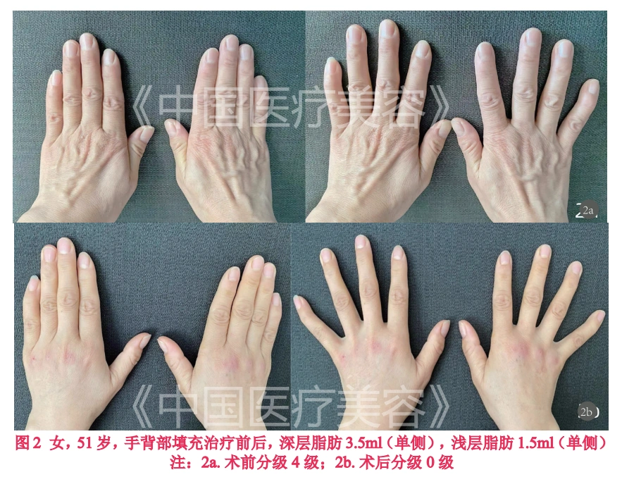 【美容外科】透明质酸注射在手部年轻化中的临床观察