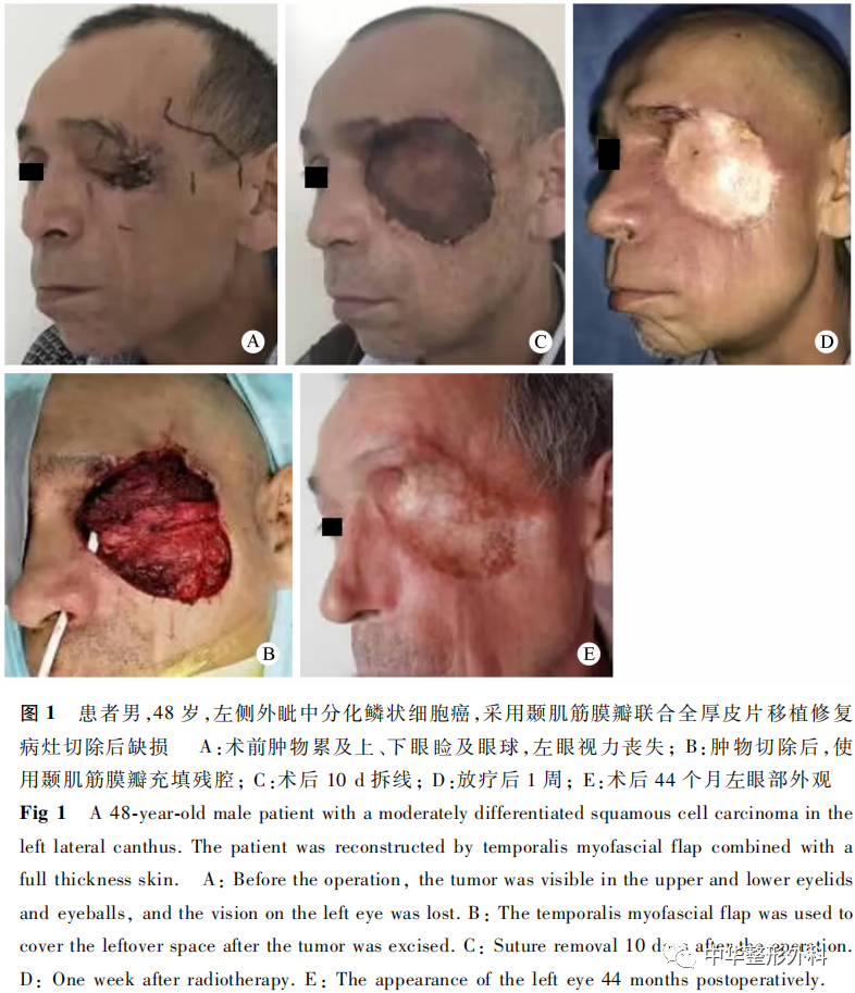 三种不同类型组织瓣修复眶区组织缺损的回顾性分析