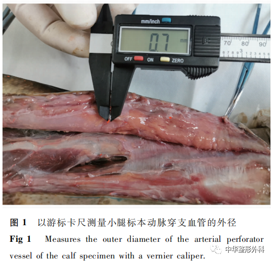 小腿链式穿支皮瓣血管三维重建的解剖学研究