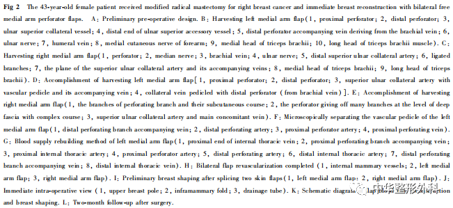 双侧臂内侧穿支皮瓣移植即刻乳房再造1例