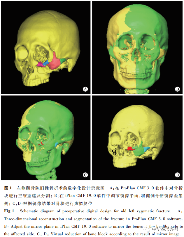 单侧颧骨陈旧性骨折患者数字外科技术辅助下切开复位内固定术后软、硬组织对称性研究