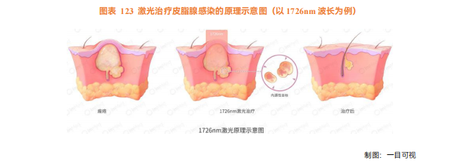 能量源设备热度再起，四大需求趋势逐渐浮现！——医美能量源设备白皮书