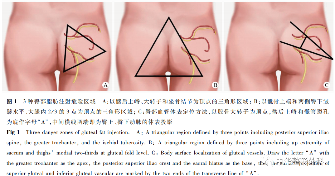 臀部脂肪移植的安全性