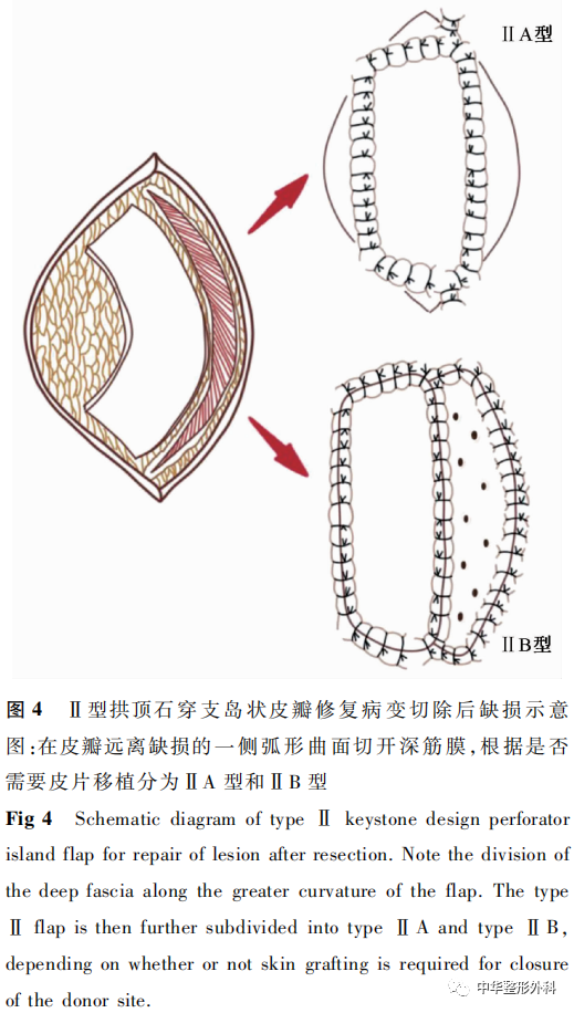 拱顶石穿支岛状皮瓣在面部缺损修复重建中的应用进展