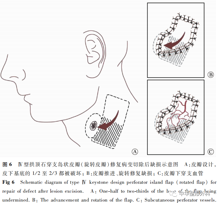 拱顶石穿支岛状皮瓣在面部缺损修复重建中的应用进展