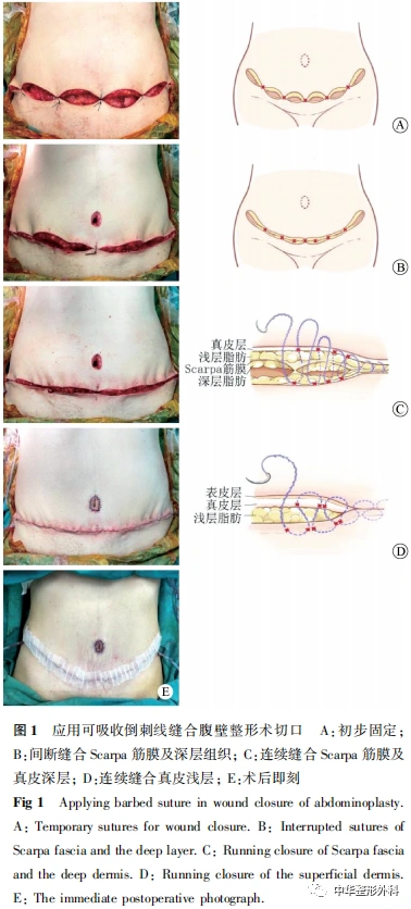 可吸收倒刺线在腹壁整形术切口缝合中的应用效果及操作技巧