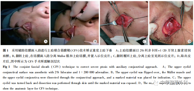 辅助结膜面入路在上睑联合筋膜鞘技术矫正重度上睑下垂中的应用