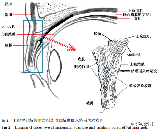 辅助结膜面入路在上睑联合筋膜鞘技术矫正重度上睑下垂中的应用