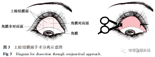 辅助结膜面入路在上睑联合筋膜鞘技术矫正重度上睑下垂中的应用