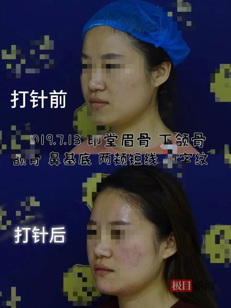 女子称花数十万整容后脸上出现肿块，美容机构：是否属于医疗事故需专业机构鉴定