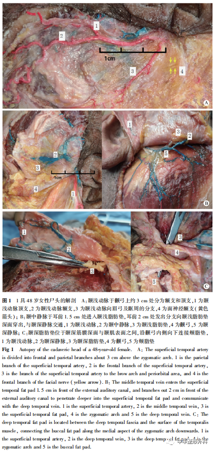 颞部脂肪室的解剖学研究及在颞部大容量脂肪移植中的意义