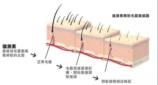 男人脱发必须要满足这两个条件