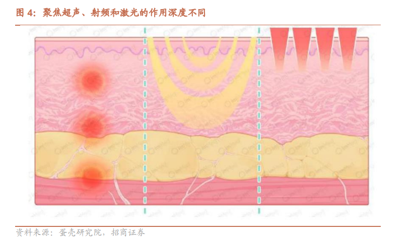 1.92亿规模的全球聚焦超声美容系统国内未来发展空间巨大（内附上市国内超声类产品大全）